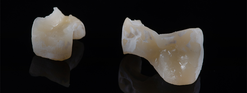 Inlays-bruts-impression-3D-Lanoiselée