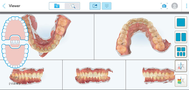 La gouttière dentaire au cœur de l'orthodontie fonctionnelle