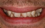 Vignette-Site-Article-alignement-Invisalign-2