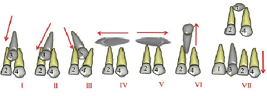 Image-canine-inclusive-maxillaire-Classification