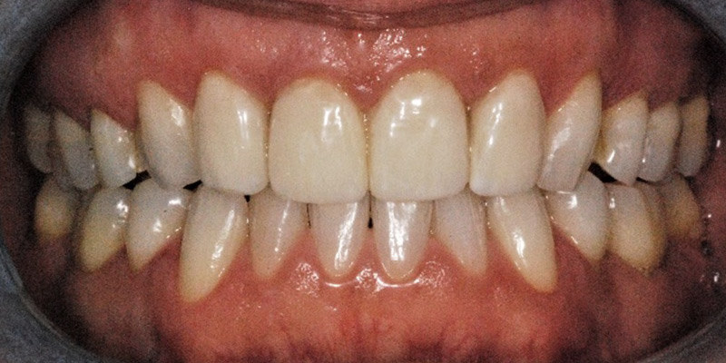 Fig-7-Apres-traitement
