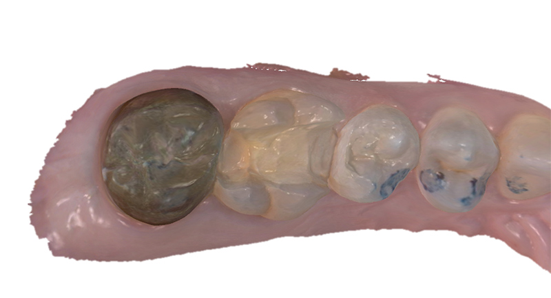 Fig-04_Permanent-Crown