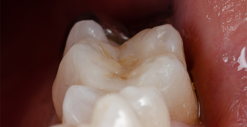 Fig-13_Permanent-Crown