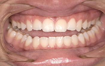 vignette_alignement-dentaire