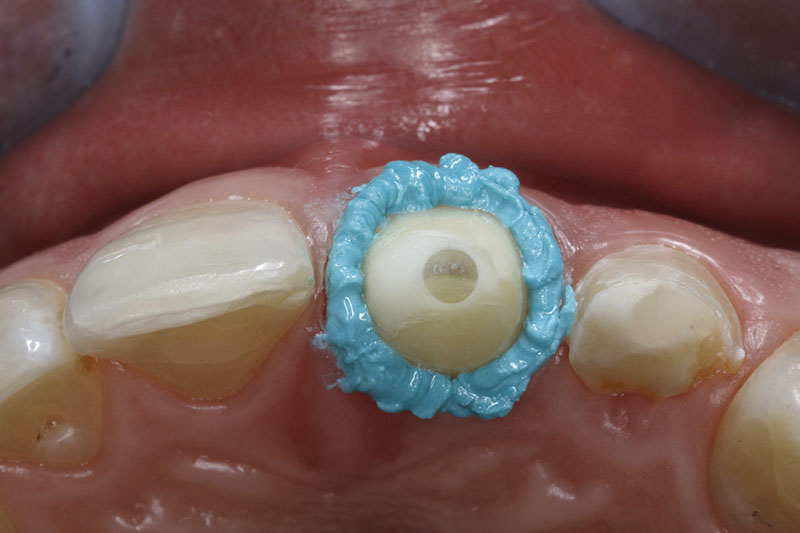 la vue incisale de la dent 21 montre la consistance stable de la pâte de rétraction