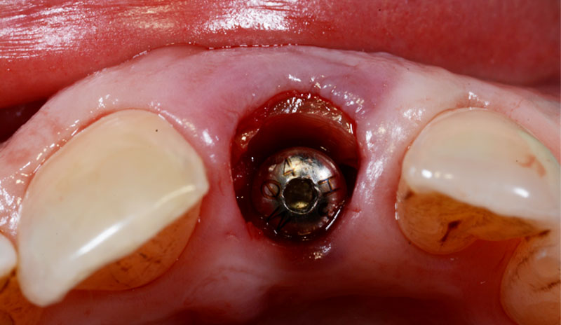 fig09-bisico-teinte