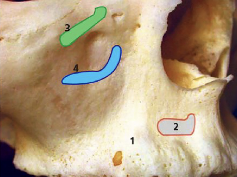Face antéro-latérale du maxillaire - L’implant osseux à visée esthétique