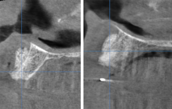 image post-opératoire immédiate - L'Implant Osseux à visée Esthétique