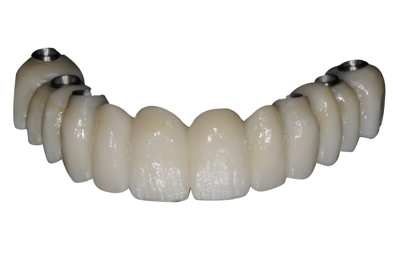 article-eoi-bridge zircone all on 6 avec cut back vestibulaire et occlusal