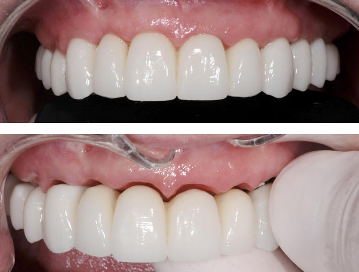 Bridge full zircone - L’Implant Osseux à visée Esthétique