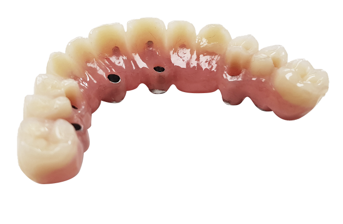 Bridge avec dents résines - L’implant osseux à visée esthétique