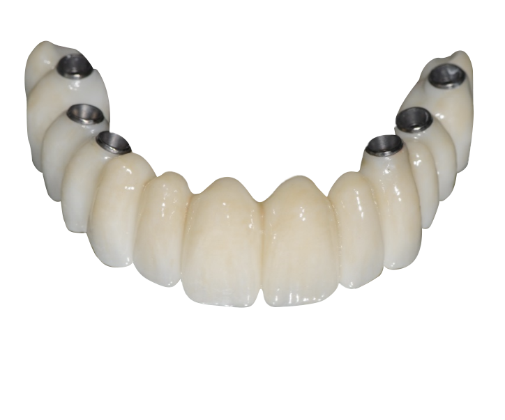 bridge all on 6 full zircone - L’implant osseux à visée esthétique