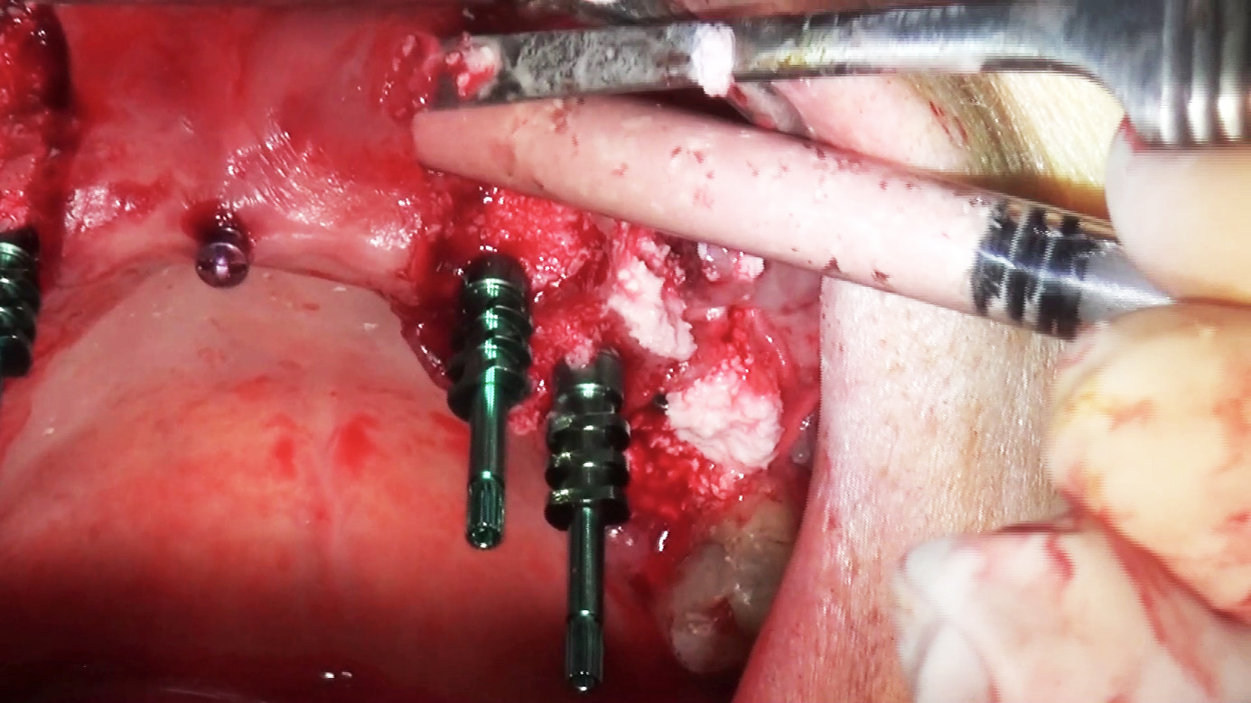 Maintien et injection simultanée de l'hydroxyapatite -L’implant osseux à visée esthétique