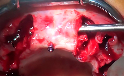 Vérification décollement total - L'Implant Osseux à visée Esthétique