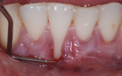 vignette-recession-gingivale-semtob