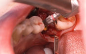 Vignette-Site-NSK-Video-Implant-10-2022-2