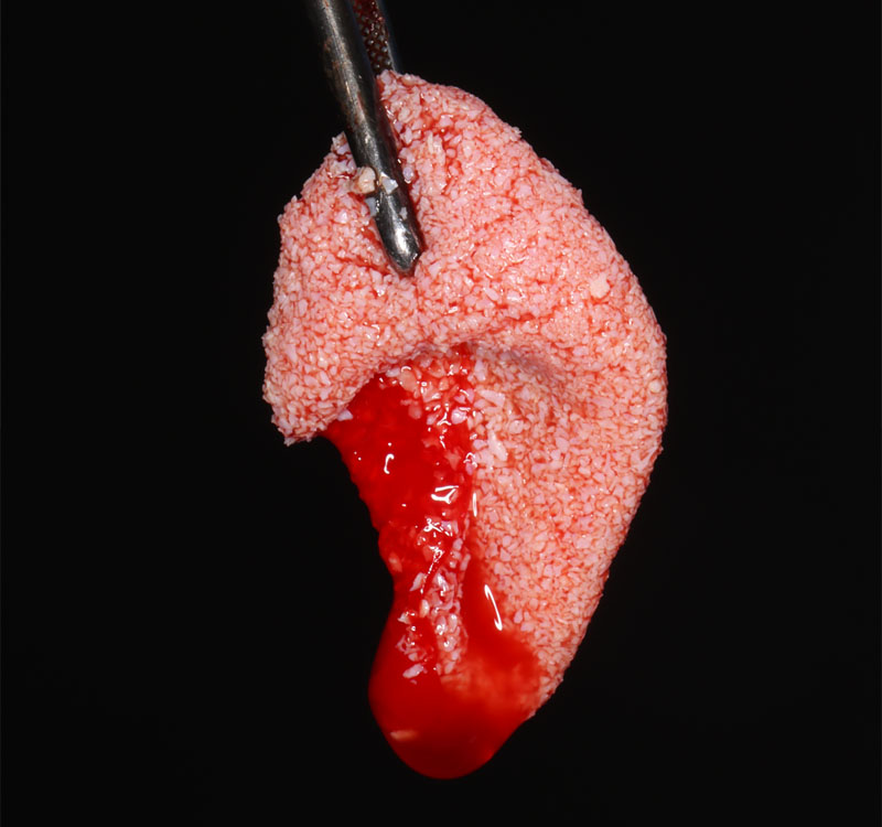 fig03-corticotomie