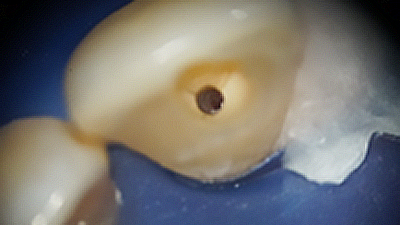 fig-08-endo-guides