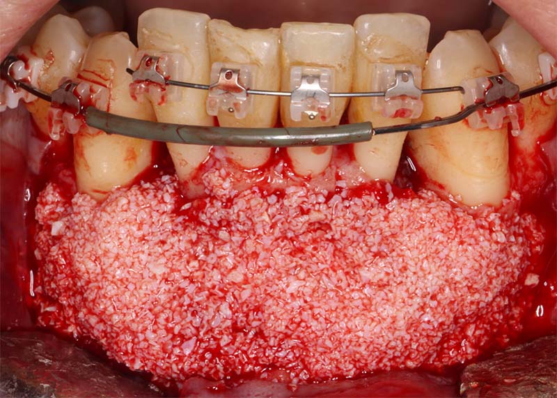fig04-corticotomies