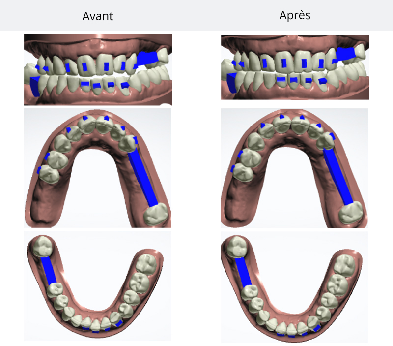 2-img2Figure 2 Simulation du traitement orthodontique (avant-après)-rehabilitation