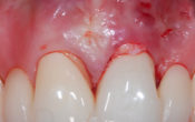 vignette-article-fenestrations-semtob
