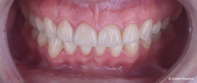 fig-20-usure