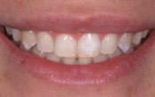 Vignette-Site-Video-Philips-Academie-du-Sourire-2