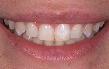 Vignette-Site-Video-Philips-Academie-du-Sourire-2