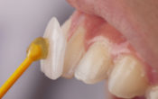 Vignette-Site-Article-Crown-Ceram