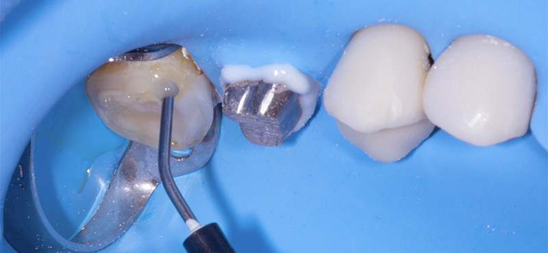 fig-13-dentisterie-Adhésif