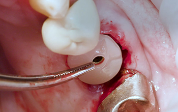 Vignette-Site-Dentalespace-Video-MIS-Linda-Martin