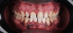 a et / and b Vues occlusales des arcades dentaires. Les 32 et 42 ont