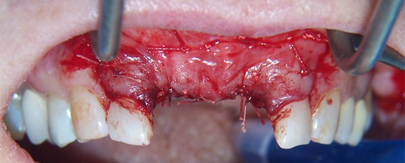 fig-08-article-Jonathan-Amar-extraction