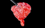Extraction implantation PRL