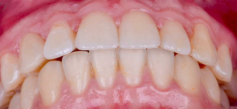Les contacts sur le joint occlusal sont éliminés et la fonction de latéralité canine allégée
