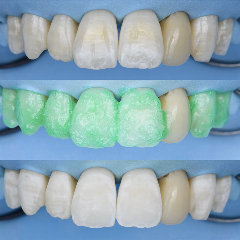 fluorose, protocole érosion infiltration sous digue