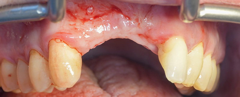 Examen clinique endobuccal de face après cicatrisation des avulsions de 12, 21 et ablation de l’implant en site 11