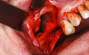 Sinus Best-of-Implantology