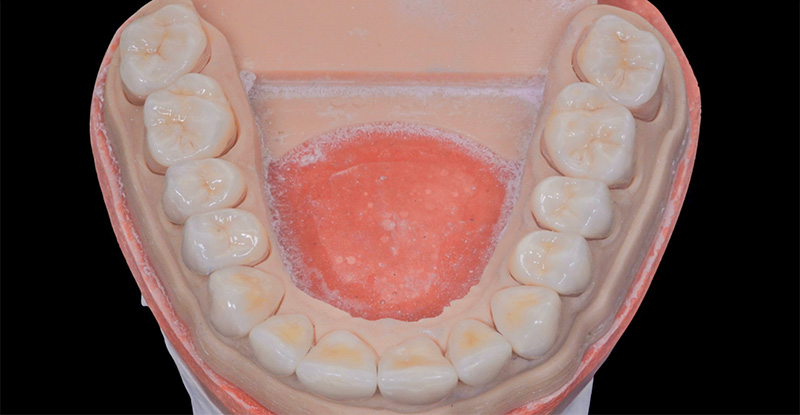 Restaurations partielles en disilicate de lithium (Emax - Ivoclar)