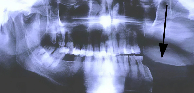 Traitements des cancers de la cavité bucale