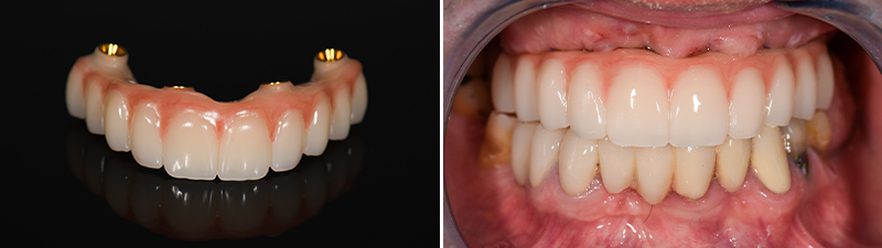 Bridge provisoire PMMA avec gencive, All-on-4