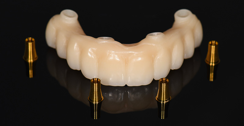 Bridge provisoire PMMA et TiBase IPD en titane nitruré, All-on-4