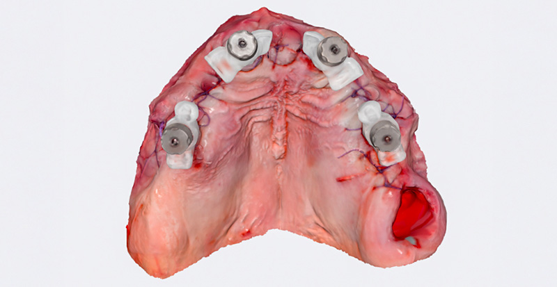 Image du scan avec les Scan-Transfers IPD en place