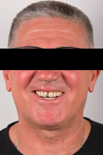 Patient avant All-on-4