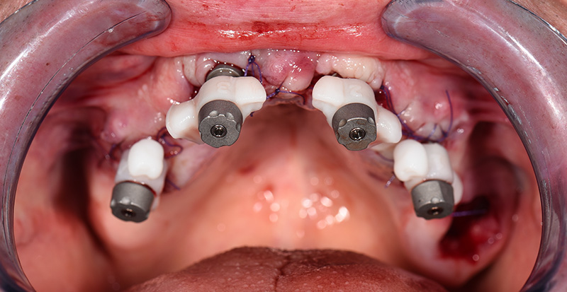 Scan-Transfers IPD en place