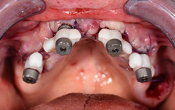 All-on-4 Scan-Transfers