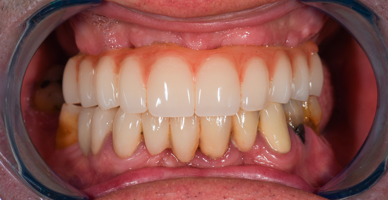 6 mois post-opératoire