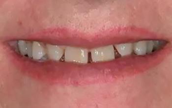 Agénésie bilatérale