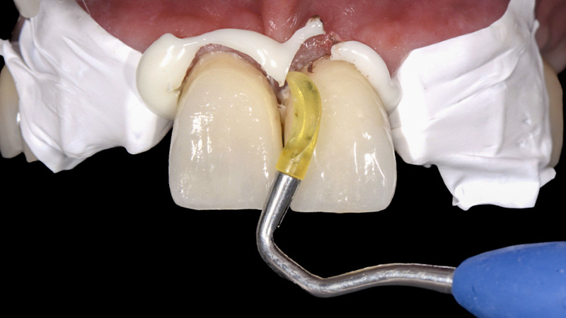 FujiCEM Evolve - Élimination de l’excès de ciment cervical des incisives centrales