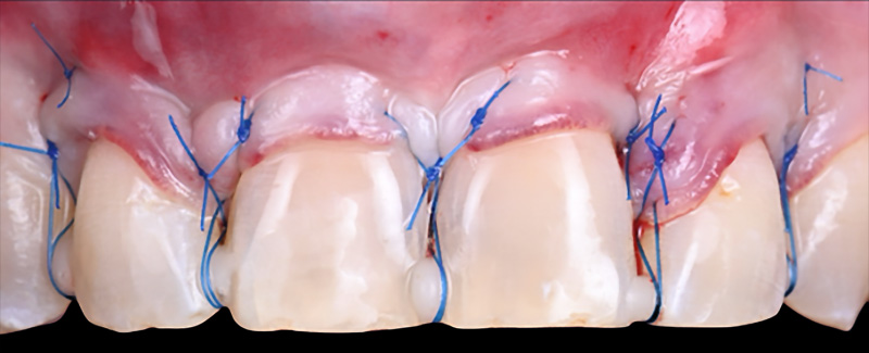 Sutures du greffon et du lambeau à l’aide de fil 6/0 et 5/0 prolène Neohm®